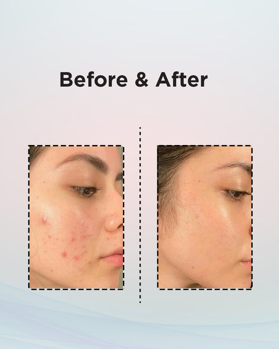 Anti Acne Cream