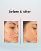 Anti Acne Cream