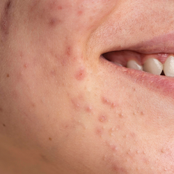 Acne Scars