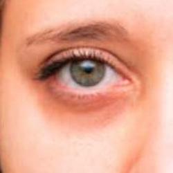 DARK CIRCLES