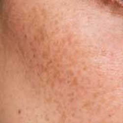 FRECKLES