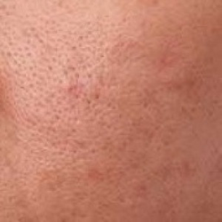 OPEN PORES