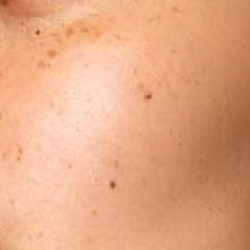 PIGMENTATION