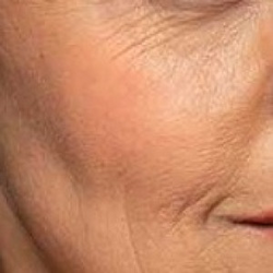WRINKLES